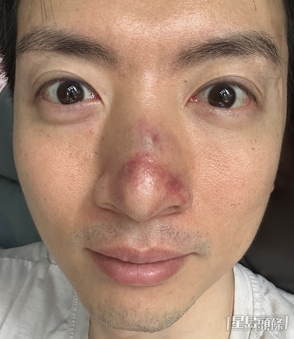 譚坤倫受傷後立即送院檢查,證實鼻骨骨折。(獨家圖片)。 譚坤倫受傷後立即送院檢查,證實鼻骨骨折。(獨家圖片)。