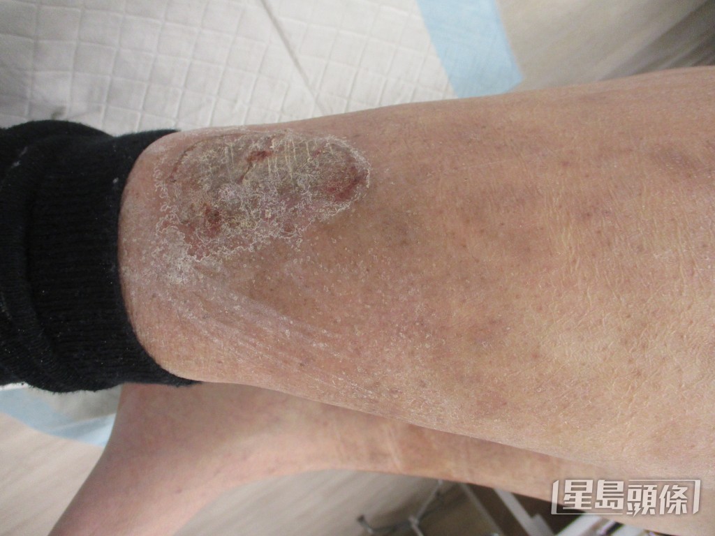 陈涌医生表示，湿疹成因杂志，有很多种类，例如异位性皮肤炎、接触性湿疹（如主妇手）、干燥性湿疹和脂漏性湿疹。（陈涌医生提供）