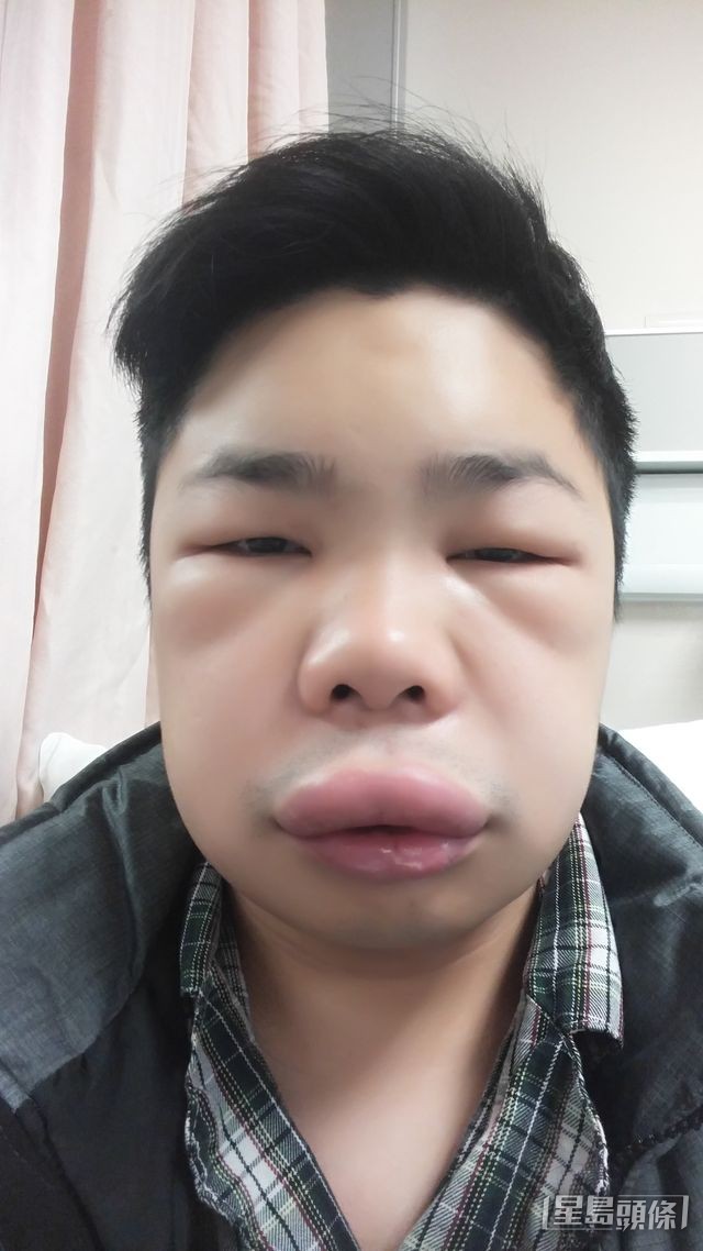 冼庭峯曾多次臉部發病,嘴唇及眼瞼嚴重腫脹,容貌判若兩人。 受訪者提供 冼庭峯曾多次臉部發病,嘴唇及眼瞼嚴重腫脹,容貌判若兩人。 受訪者提供