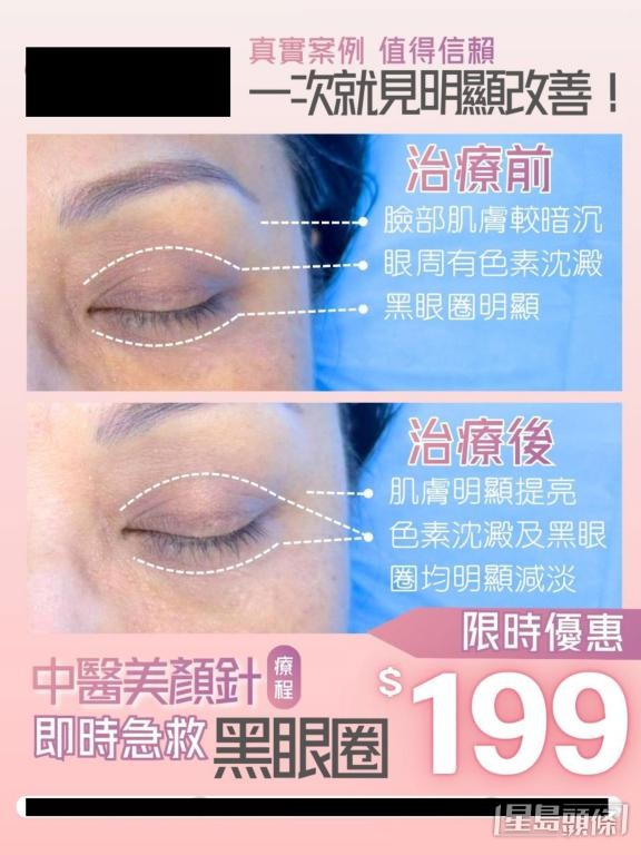 有機構展示前後對比圖，標榜中醫美顏針只需一次療程即可改善黑眼圈。 網上截圖