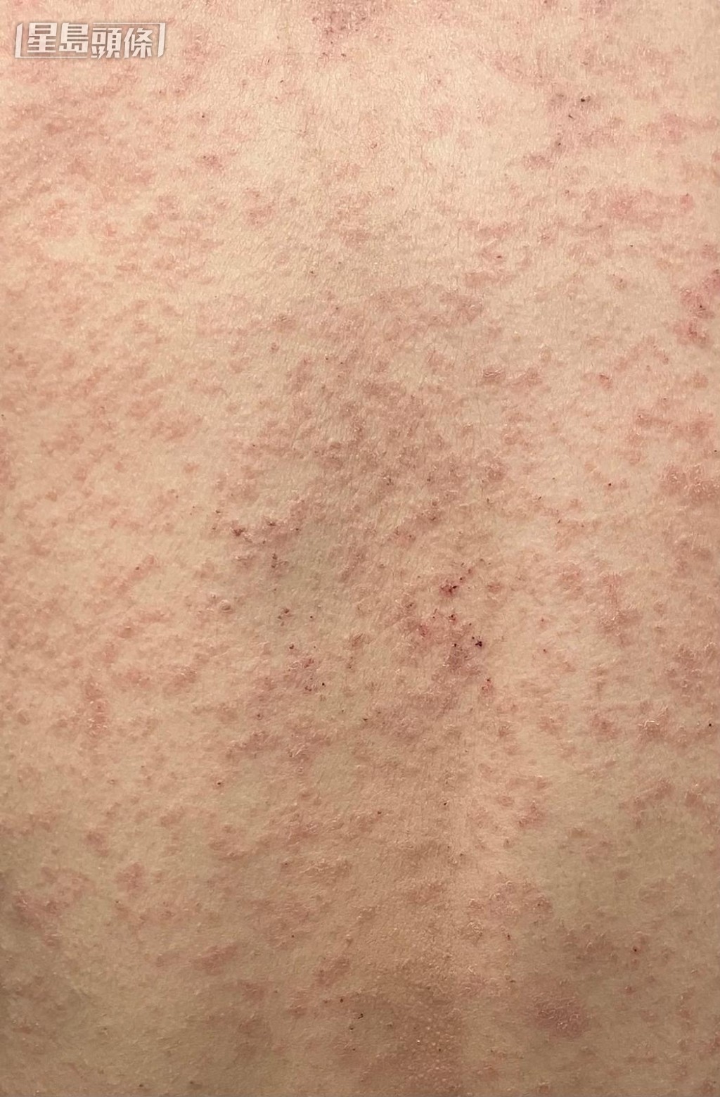 嚴重的濕疹,濕疹的邊界比較模糊。(受訪者提供) 嚴重的濕疹,濕疹的邊界比較模糊。(受訪者提供)