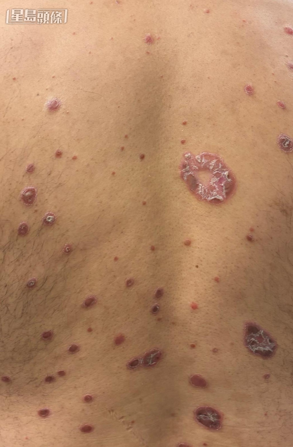 尋常型銀屑病,銀屑病的邊界比較清晰。(受訪者提供) 尋常型銀屑病,銀屑病的邊界比較清晰。(受訪者提供)