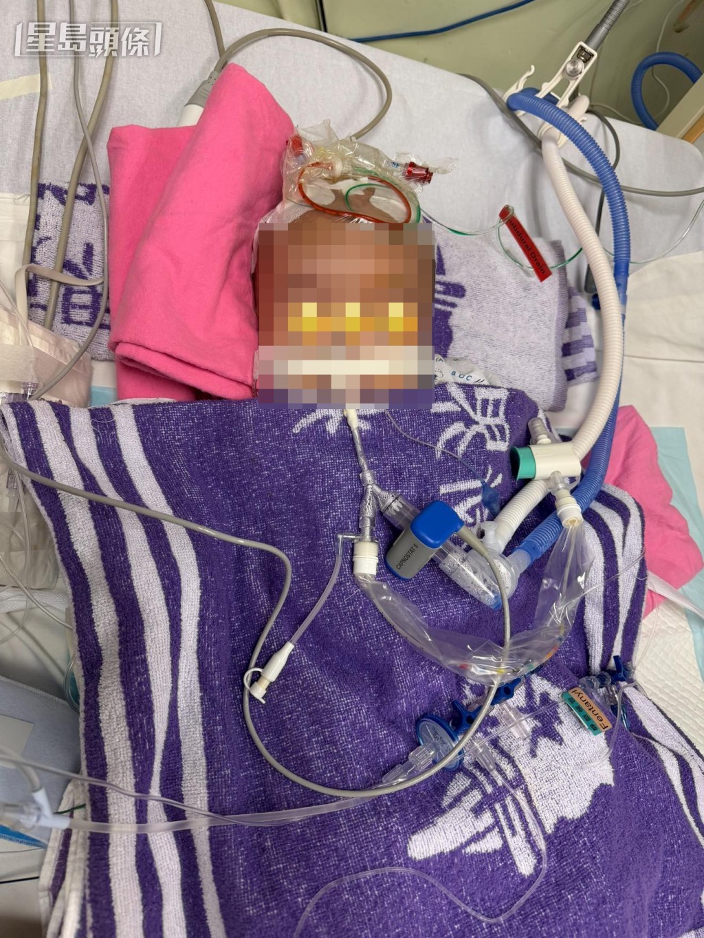 盧先生指兒子「細波」早前已接受手術，現時留醫兒童深切治療部。網上圖片