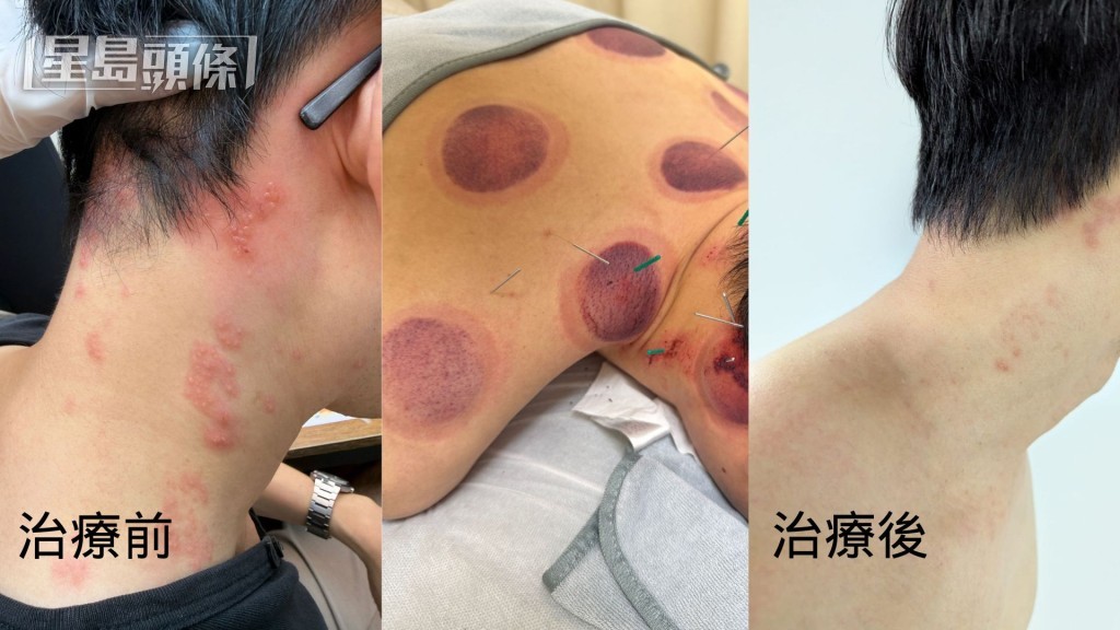 该名男性患者配合清热祛湿的中药方剂，于2周后完全康复。（图片来源：注册中医师黄晶晶）