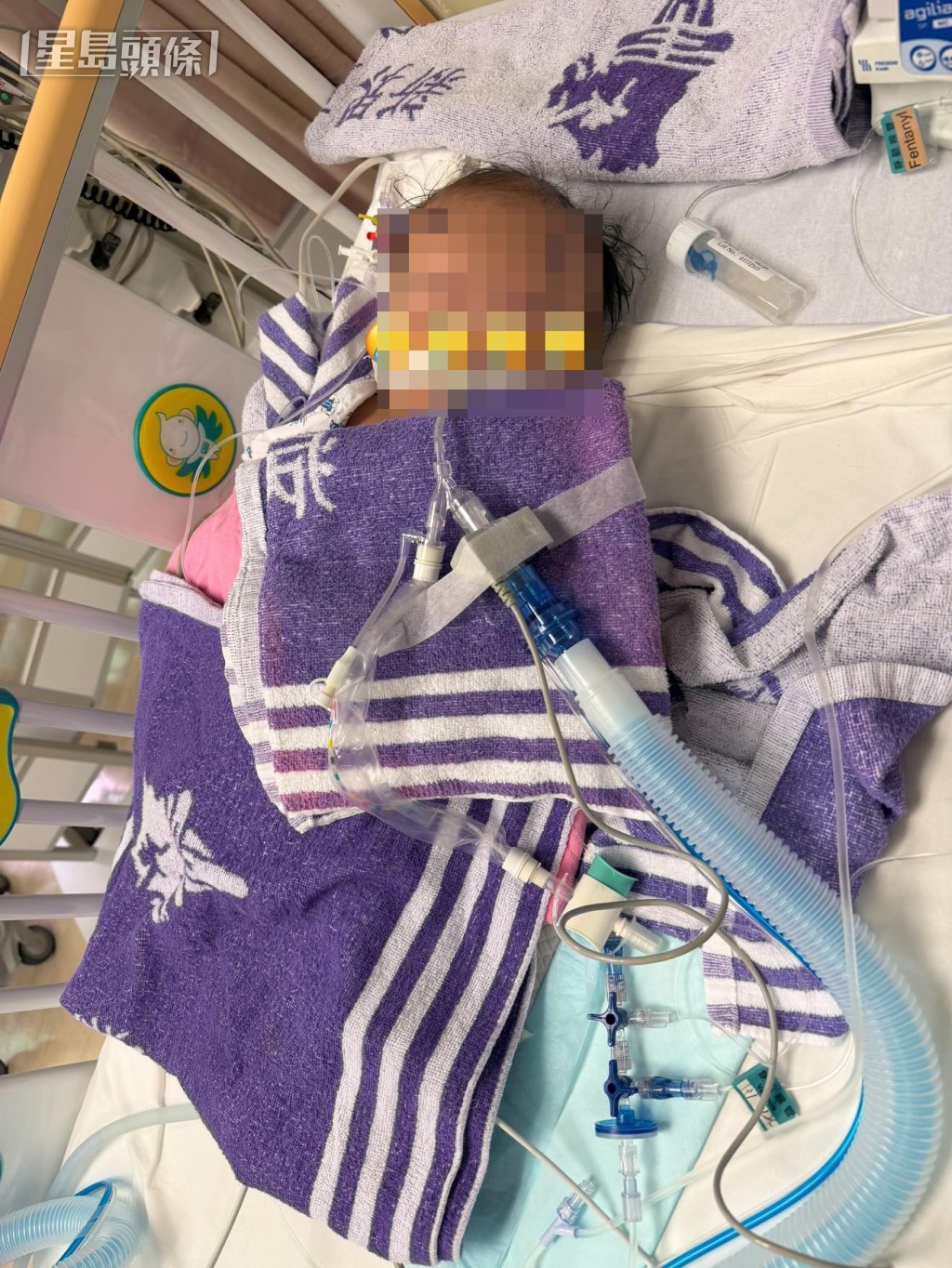 盧先生指兒子「細波」早前已接受手術，現時留醫兒童深切治療部。網上圖片