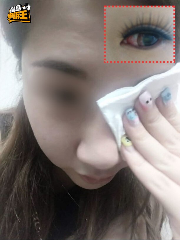 陳小姐左眼被打至視網膜脫落，僅剩一成視力。(被訪者提供圖片)