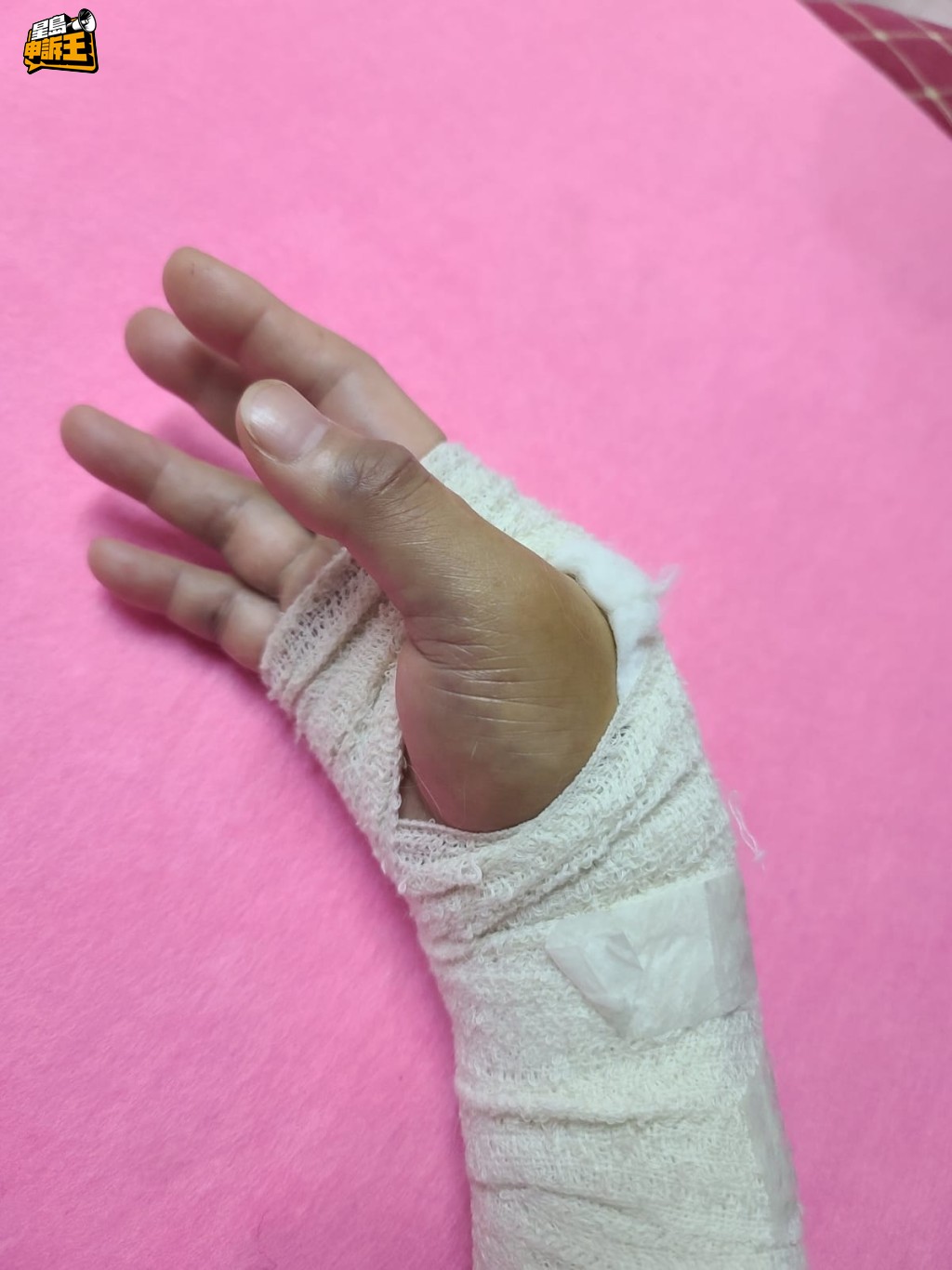 因為工作期間滑倒致手骨碎裂,吳女士要停工休息了半年。(相片來源:受訪者提供) 因為工作期間滑倒致手骨碎裂,吳女士要停工休息了半年。(相片來源:受訪者提供)