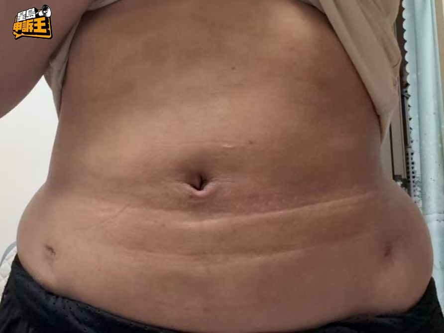 陳小姐未消水腫時，肚子位置一度出現一層又一層的皺褶。(來源：被訪者提供)