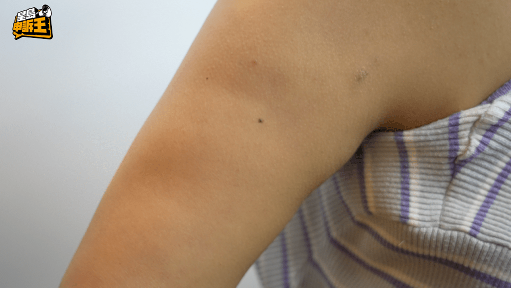 陳小姐在抽脂手術半年後，手臂仍出現凹凸不平的情況。(來源：被訪者提供)