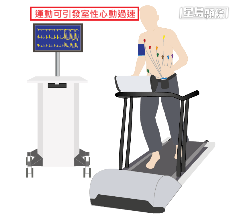  運動可引發室性心動過速（圖片來源：朱賢文 香港都會大學護理及健康學院高級講師）