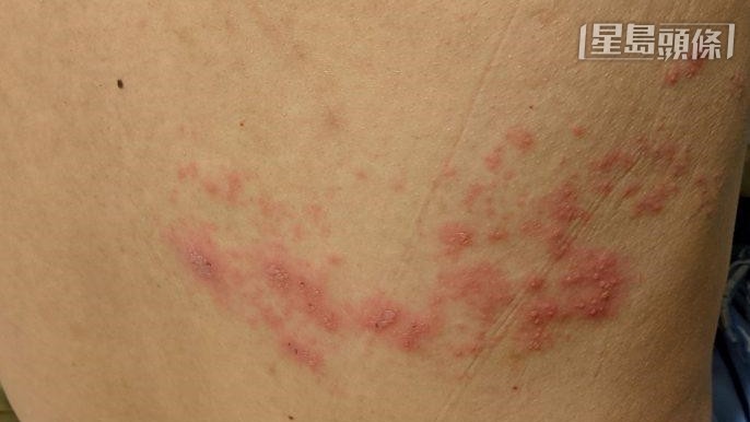 本港每3人即有一人曾經患有俗稱「生蛇」的帶狀疱疹,而且有年輕化的趨勢。資料圖片 本港每3人即有一人曾經患有俗稱「生蛇」的帶狀疱疹,而且有年輕化的趨勢。資料圖片