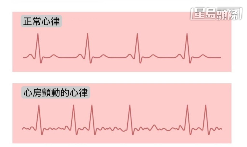 正常心律 VS 心房顫動的心律(心臟科專科醫生郭俊傑提供) 正常心律 VS 心房顫動的心律(心臟科專科醫生郭俊傑提供)