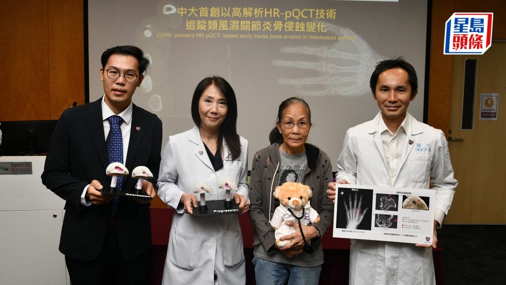 中大首創3D高解析度掃描 3分鐘驗出類風濕關節炎 助逾半嚴重患者「早診早治」
