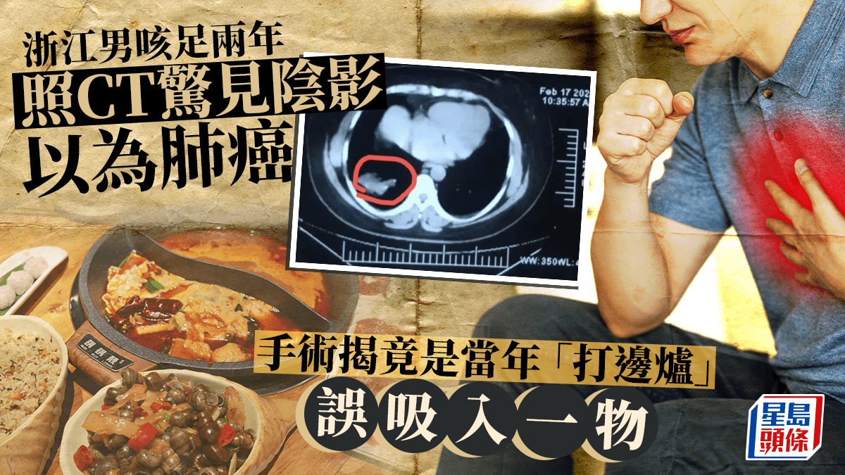 浙江男咳足兩年CT有陰影以為肺癌 手術發現竟是「打邊爐」害的