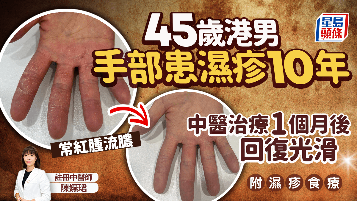 長期手部濕疹:個案與護理貼士