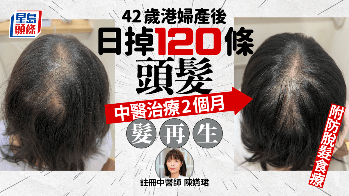 產後脫髮個案及日常護髮