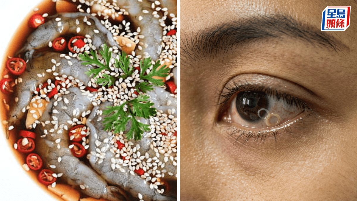 泰國女子食醃生蝦 寄生蟲入眼險盲 專家警告嚴重可上腦致命