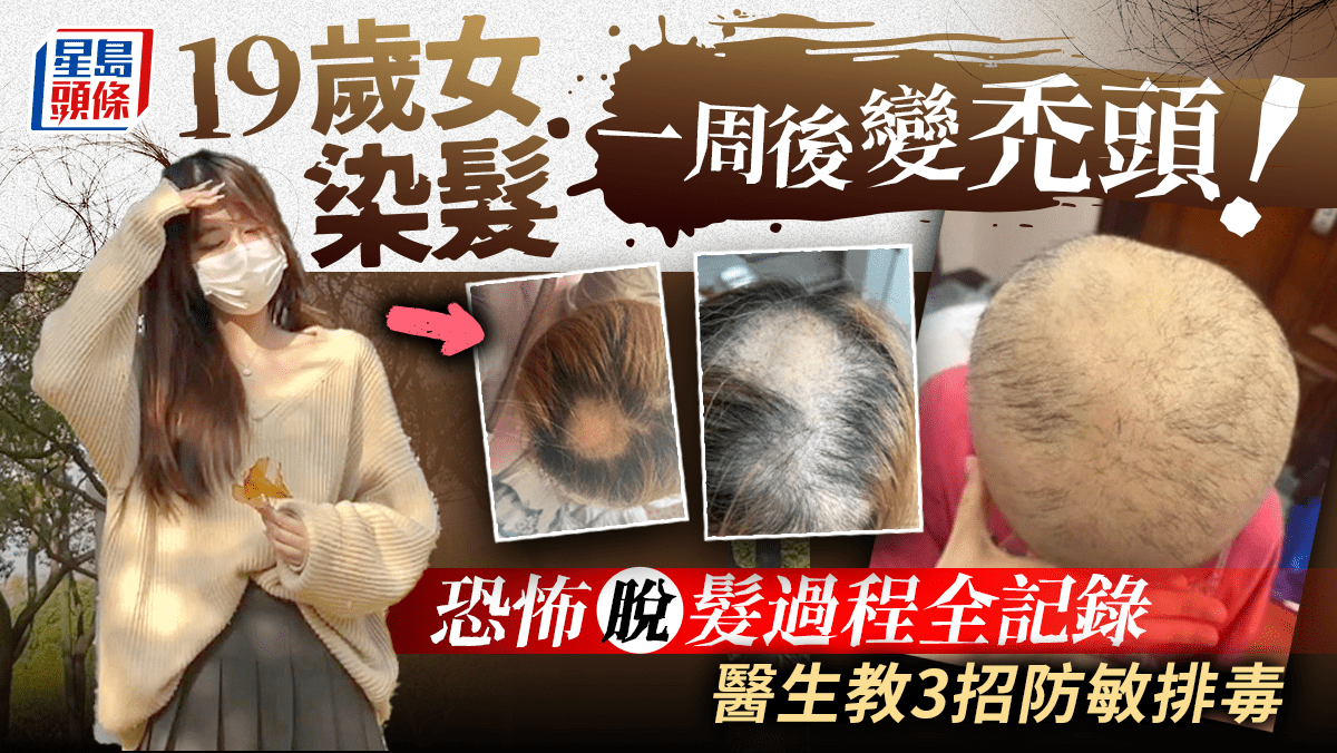 Cautionary Tale: Woman Experiences Hair Loss after Hair Dyeing; Doctor Provides Tips for Allergy Prevention and Detoxification