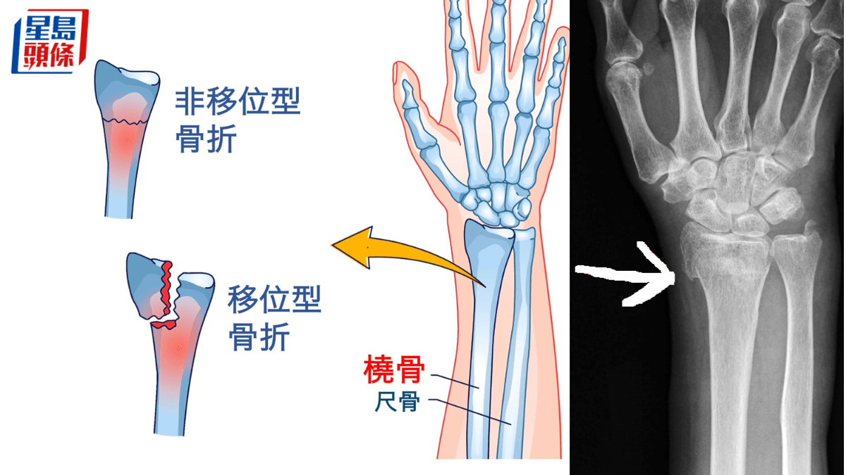 專欄 運動醫道｜橈骨骨折少兒最常見