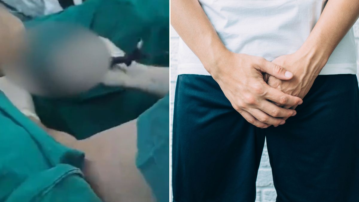 深圳無知男為增雄風DIY注射硅膠  「蘿蔔」下體潰爛發臭求醫