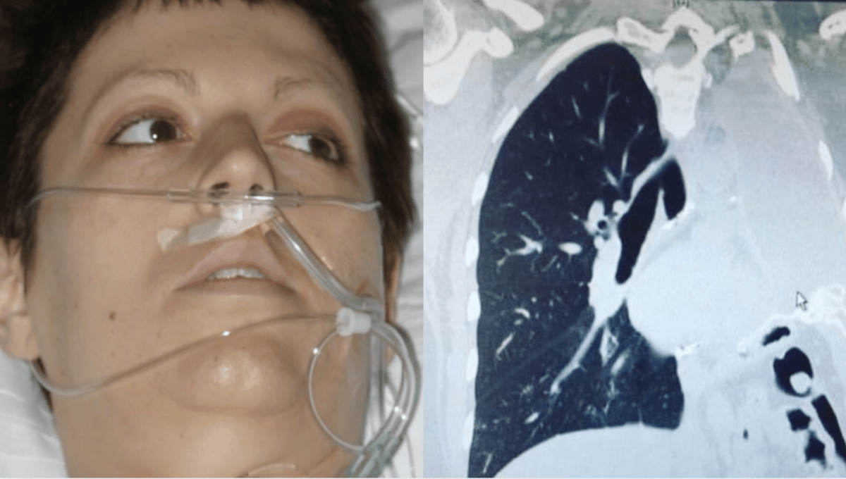 童年愛著父親外套埋禍根 美國女子被告知罹癌僅餘15個月命