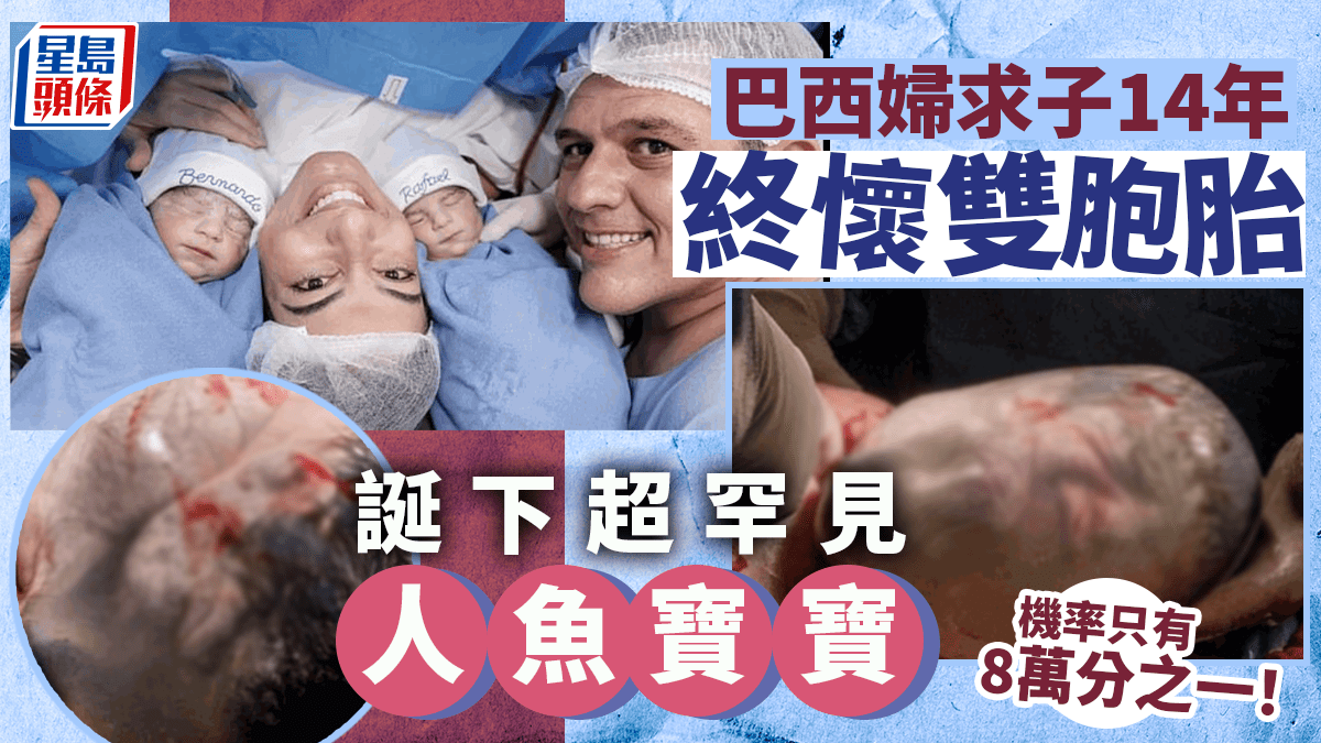 求子14年終懷雙胞胎巴西婦驚喜誕下超罕見「人魚寶寶」