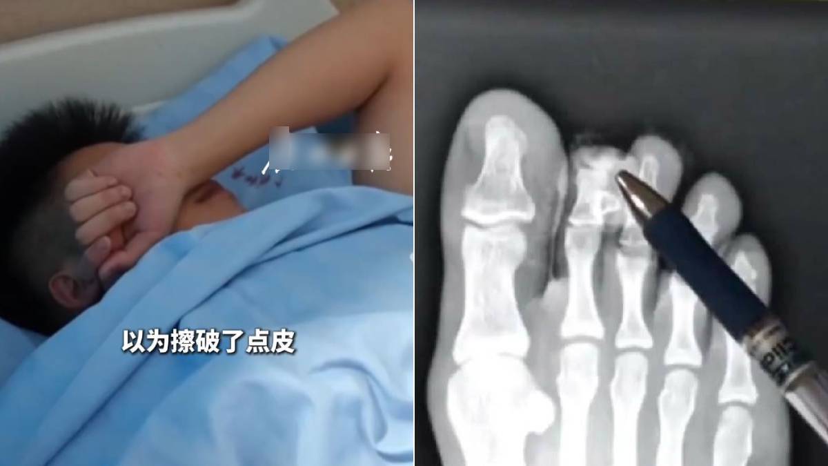 廣東「省鞋」︱16歲仔著人字拖行路玩手機  踢中石頭一截腳趾「飛走」