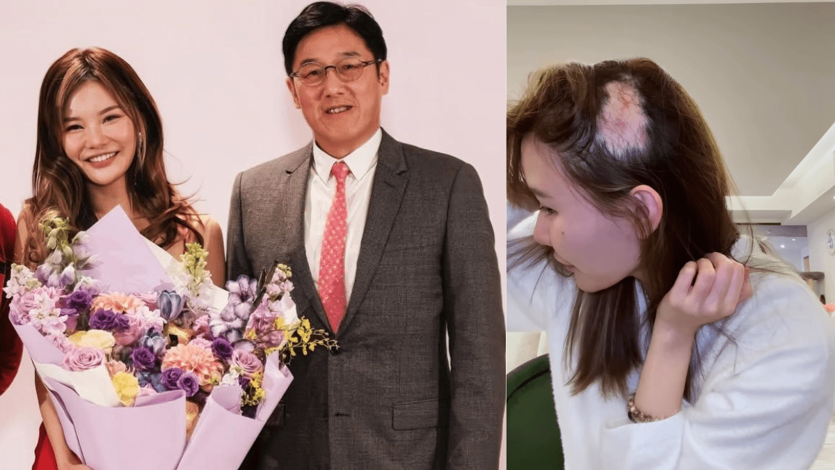 「最強小三」五索嚴重鬼剃頭  公開大範圍脫髮照：禿到咁樣  拆解導致斑禿3大原因