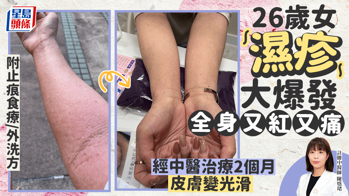 反覆濕疹個案及洗澡護理