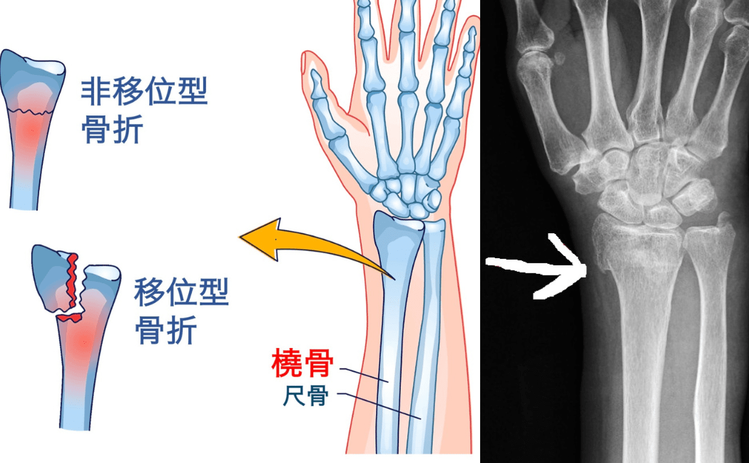 專欄 運動醫道｜橈骨骨折因人施治