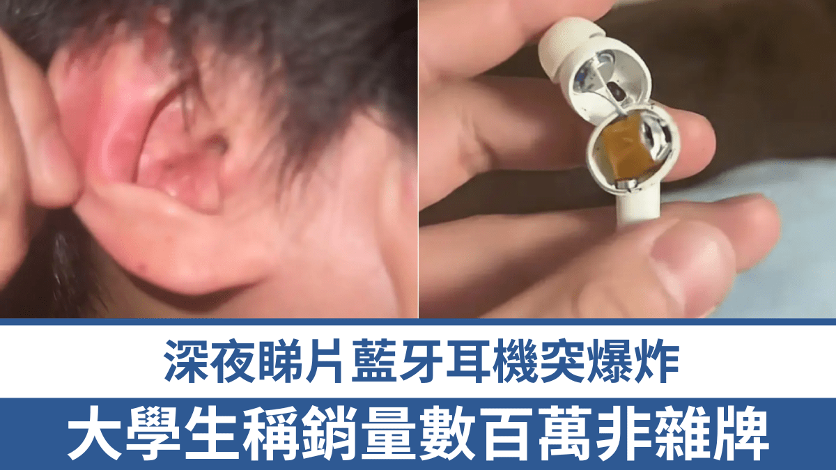 藍牙耳機｜網購熱銷百萬耳機突爆炸 鄭州大學生險失聰