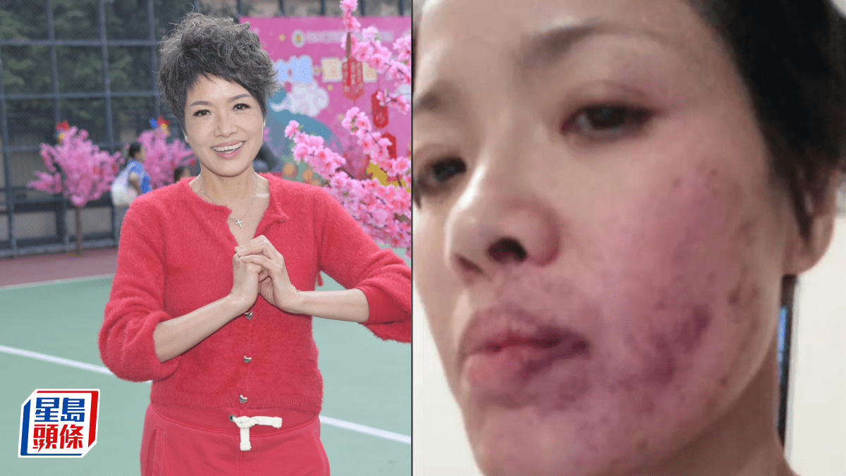 寶珮如被掌摑傷痕照曝光  半邊臉佈滿深紫瘀傷  微絲血管爆裂觸目驚心  打人者係金像女星