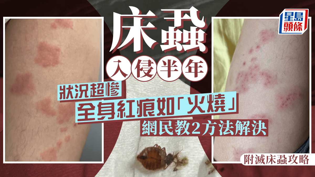 港男大呻全屋被床蝨入侵大半年 慘被蝨咬全身佈滿紅痕如「火燒」 網民教2方法解決 (附滅床蝨攻略)