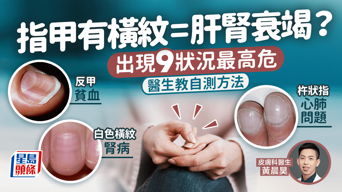指甲健康|指甲有橫紋等於肝腎衰竭?出現杵狀指9種狀況最高危 附自測方法