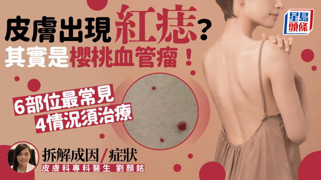 皮膚突然出現紅痣?其實是櫻桃血管瘤 4情況須治療 醫生拆解成因/症狀